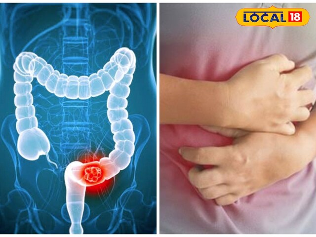 बदलती जीवनशैली के कारण युवाओं में कोलोरेक्टल कैंसर का बढ़ता खतरा