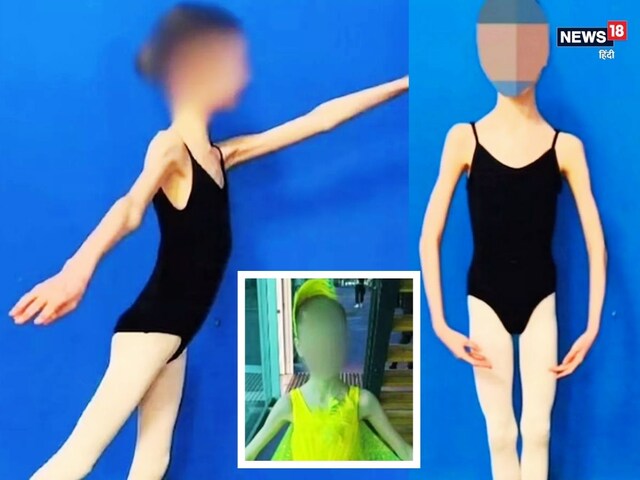 मां-बाप ने बेटी को बनाया 'चलता-फिरता कंकाल', वज़न रह गया 25 किलो!