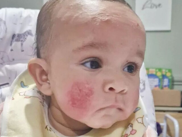 Gemma-Leighanne-eczema-Liviah-West-Midlands-steroid-cream-Balmonds-Skin-Salvation-Rare-Illness-2025-03-e1da587379b8d0e97c02620629221944 England's mother cured daughter's eczema in 2 days with natural treatment