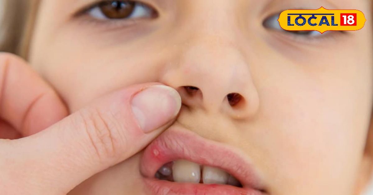 Home Remedies Mouth Ulcer: मुंह में हो गए छाले तो अपनाएं घरेलू ये नुस्खे