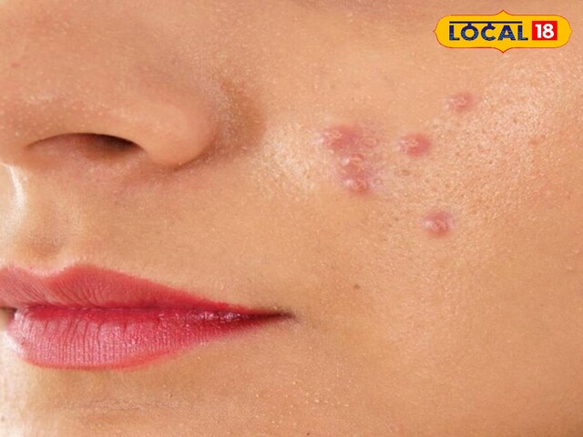 Pimples