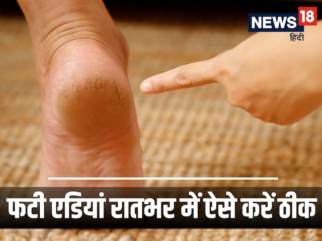 फटी एडियों से छुटकारा दिलाएंगे 5 घरेलू नुस्खे ! दवा से भी ज्यादा असरदार, रातभर में दिखेगा असर फटी एडियों से छुटकारा दिलाएंगे 5 घरेलू नुस्खे ! दवा से भी ज्यादा असरदार, रातभर में दिखेगा असर