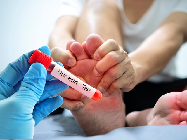 Does uric acid increase again and again? Eat these 5 sour things to control Does uric acid increase again and again? Eat these 5 sour things to control