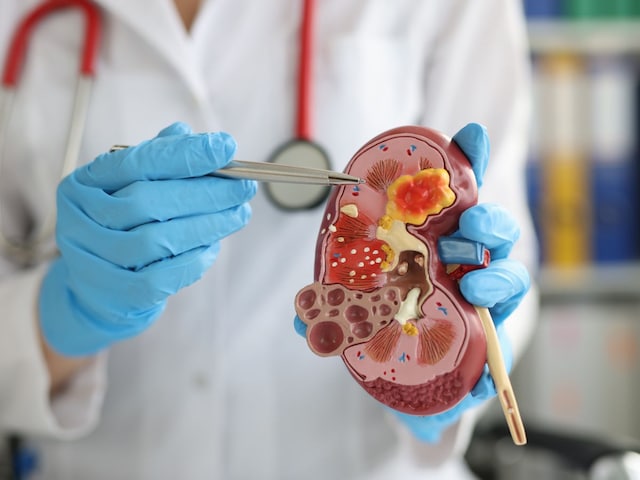 Kidney diseases are increasing due to these 5 reasons! Reform habits in time, otherwise ...