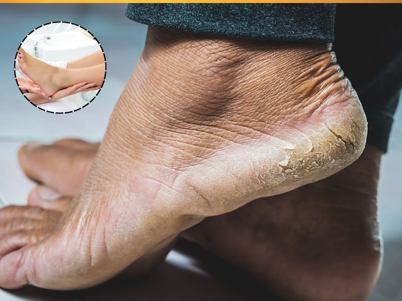 Cracked Heels Home Remedy, Natural treatment for dry heels, lemon, banana, glycerin, aloe vera for feet care