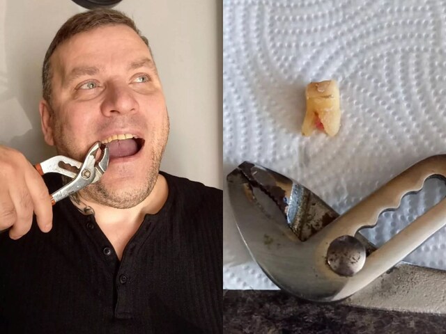 Kaspars-Grenenbergs-Man-pulled-out-his-teeth-Man-suffering-from-toothache-treatment-of-toothache-2025-04-f75215bc55d7d9942479211b3679f2fc England: Troubled by toothache, a person uprooted his teeth from wrench
