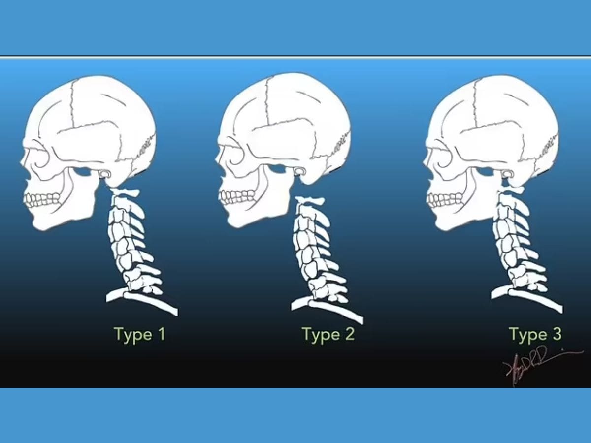 Neck-broken-in-car-accident-head-separated-from-body-miracle-saved-life-2025-04-ca70884b0d561beef721c6e3be9aedfa Broken neck in accident, head separated from the body, yet survived alive, know how?