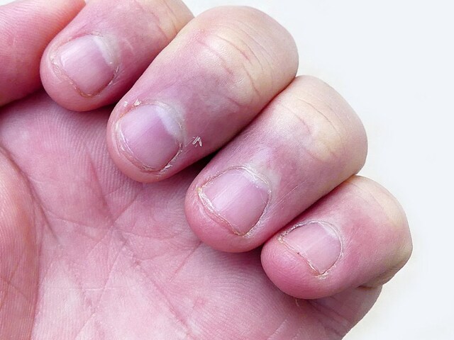 Has the skin around the nail, is a bad condition from pain? Adopt these 5 remedies