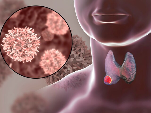 The risk of thyroid cancer in children of this age is high, research was revealed