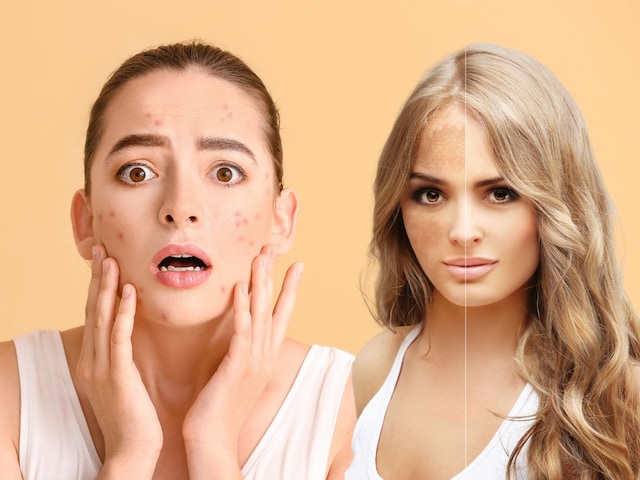 In teenage, acne, pigmentation has spoiled the face, reasons to know this work In teenage, acne, pigmentation has spoiled the face, reasons to know this work