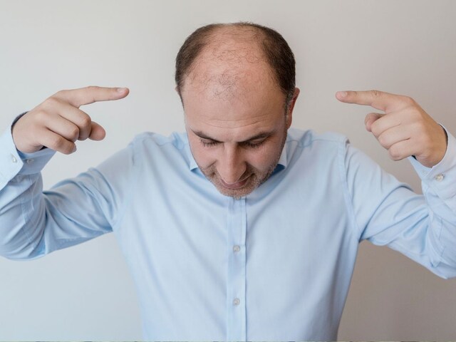 Which vitamin deficiency causes hair loss? If you read this news will not be bald