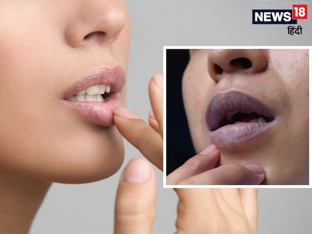 What is the meaning of drying and bursting lips? Which vitamin is lacking, know what to eat What is the meaning of drying and bursting lips? Which vitamin is lacking, know what to eat