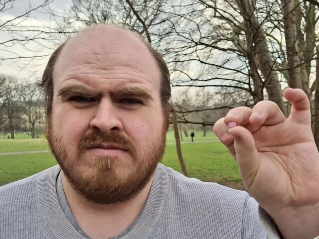 toy-stuck-in-year-2025-04-dcbd97e06e037decfed568e6e1e39198 Man Thought He is Getting Deaf Found Toy Stuck in Boy Ear from 20 Years Scotland Bizarre News | There used to be terrible pain in the boy's ear, not even the benefit of medicine, such a thing came out one day, flew away after seeing!