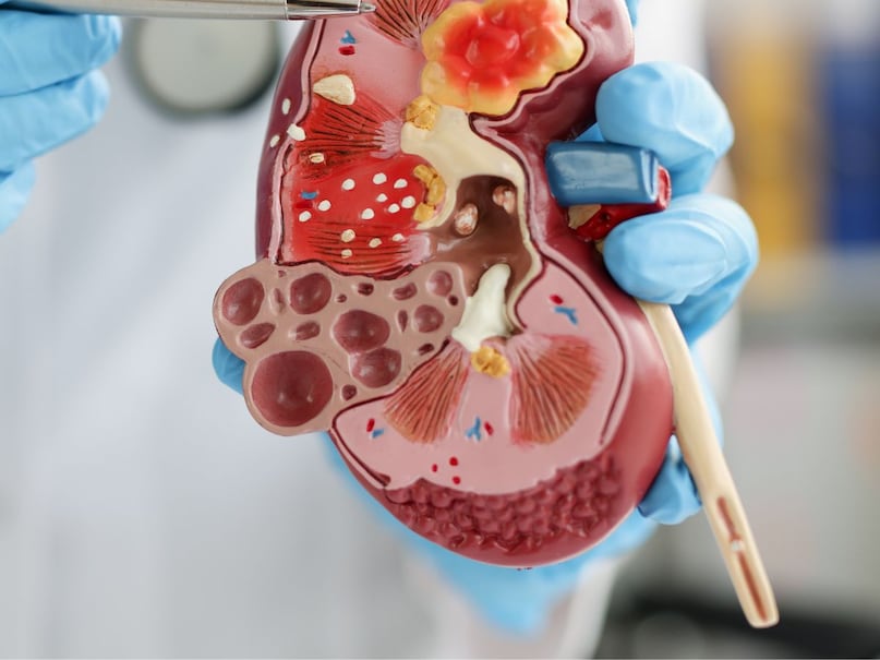 How to avoid kidney stones,Oxalate-rich foods to avoid, Healthy kidney diet, Hydration for kidney health, Dr. Mohit Khirbat kidney advice, How to avoid kidney stones,Oxalate-rich foods to avoid, Healthy kidney diet, Hydration for kidney health, Dr. Mohit Khirbat kidney advice,