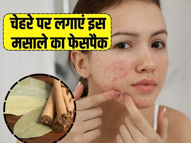 एक्‍ने और पिंपल्‍स से हैं परेशान? चेहरे पर लगाएं मसाला फेस पैक, जानें तरीका