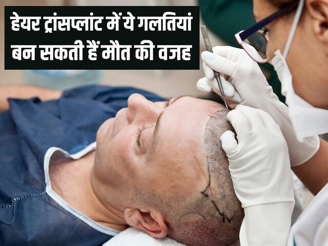 गजब हाल है ! डेंटिस्ट ने कर दिया हेयर ट्रांसप्लांट, 2 इंजीनियर्स की मौत, जानें कैसे और कहां कराएं यह सर्जरी