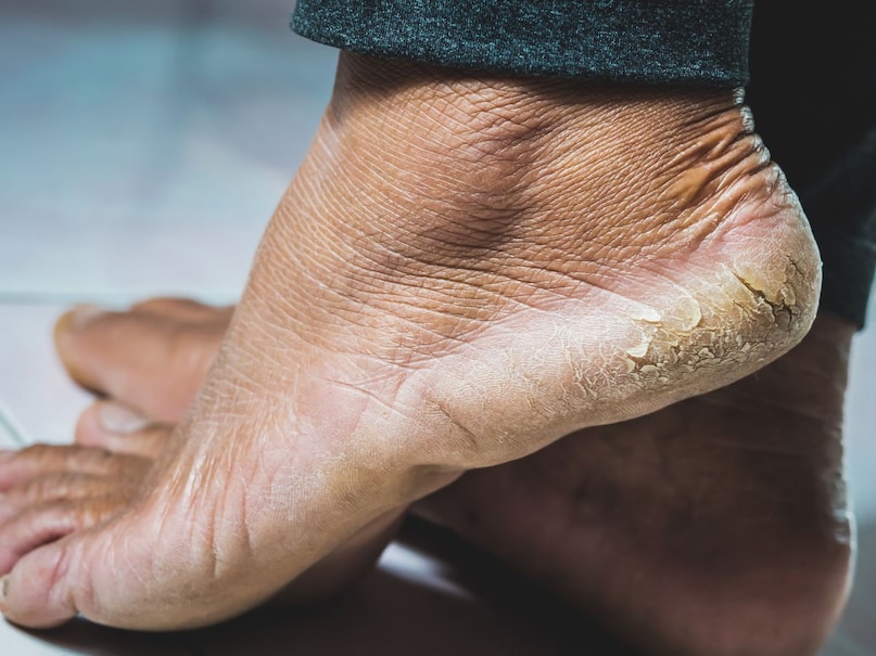 Cracks start coming in the ankles due to lack of these vitamins. (Canva) Cracks start coming in the ankles due to lack of these vitamins. (Canva)