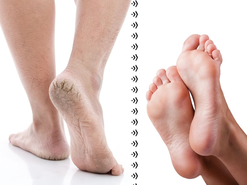Cracked heels Cracked heels