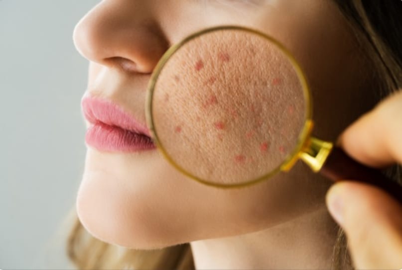 If there is a deficiency of zinc mineral in the body, then there are many problems in the skin. First of all, the skin becomes thin, due to which the risk of infection in the skin increases. This increases the dryness in the skin and causes many types of viral, vectorial infections. The biggest disadvantage is that it is very difficult to recover when the wound occurs. Image: Canva If there is a deficiency of zinc mineral in the body, then there are many problems in the skin. First of all, the skin becomes thin, due to which the risk of infection in the skin increases. This increases the dryness in the skin and causes many types of viral, vectorial infections. The biggest disadvantage is that it is very difficult to recover when the wound occurs. Image: Canva