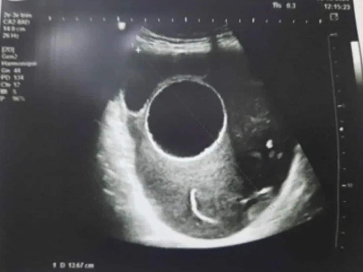 tapeworm egg in pregnant woman pelvis