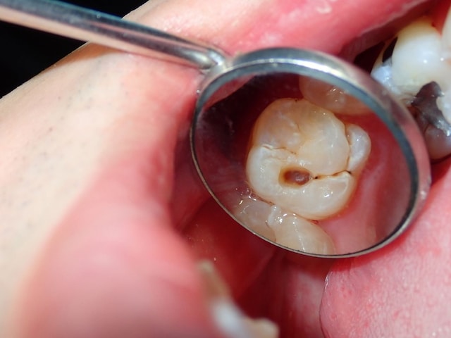 Tips To Get Rid of Cavities and Tooth Pain : दांतों की सड़न और दर्द से कैसे पाएं छुटकारा? जानें बेहद आसान तरीके - News18 हिंदी
