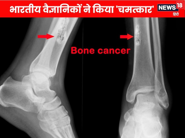 सिर्फ बूंदभर खून और मिनटों में रिपोर्ट… कैंसर के खिलाफ मेड-इन-इंडिया हथियार