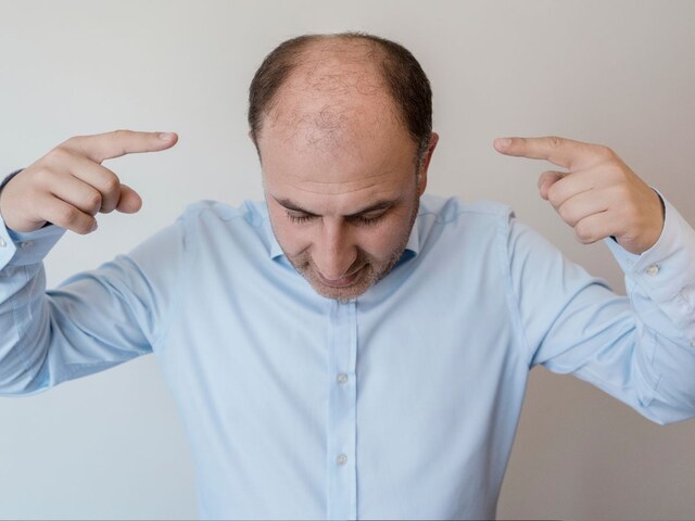 5 Bad Habits That Cause Premature Baldness | उम्र से पहले गंजापन लाने वाली 5  आदतें - News18 हिंदी