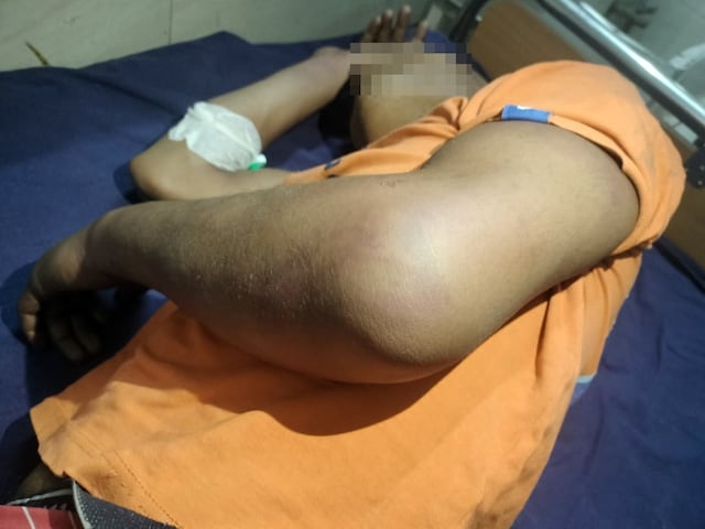 दलित युवक से हैवानियः बाल काटकर गंजा किया, मारपीट के बाद पलकें भी काट दीं दलित युवक से हैवानियः बाल काटकर गंजा किया, मारपीट के बाद पलकें भी काट दीं