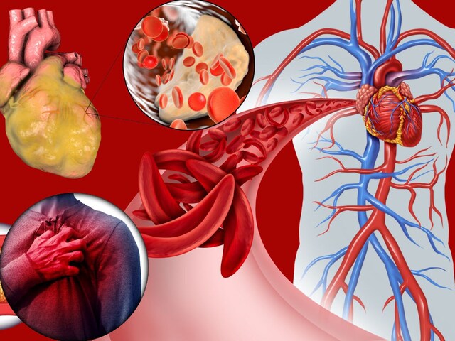 हार्ट में ब्लॉकेज कब और क्यों आते हैं? बचने के लिए 3 चीजों का जूस मिलाकर पीएं