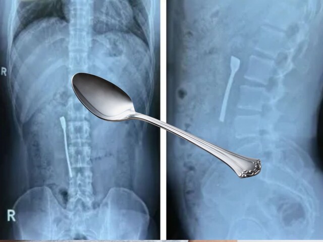 The person swallowed a teaspoon of 8 centimeters, then how the doctors pulled out, is interesting