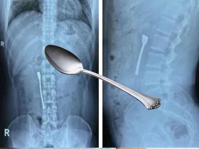 The person swallowed a teaspoon of 8 centimeters, then how the doctors pulled out, is interesting The person swallowed a teaspoon of 8 centimeters, then how the doctors pulled out, is interesting