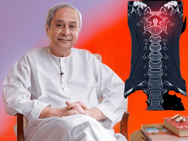 What is cervical arthritis in which Naveen Patnaik has to undergo surgery