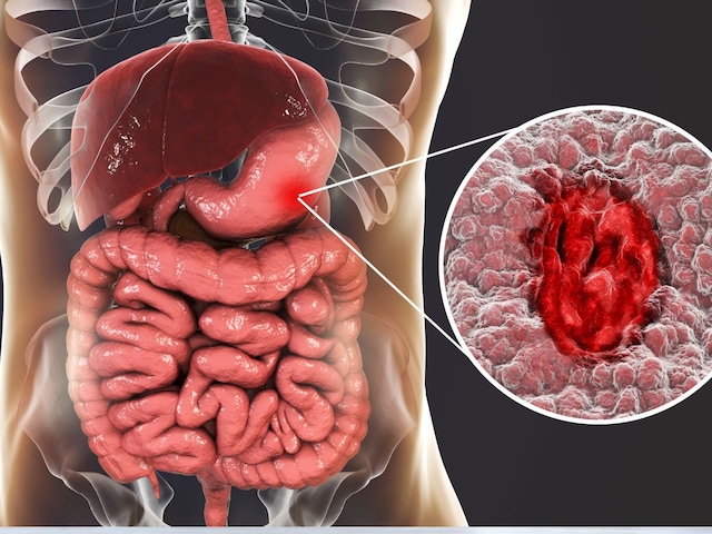 Pen killer medicine will be ulcers in the stomach, dangerous to take from your mind, learn from the doctor Pen killer medicine will be ulcers in the stomach, dangerous to take from your mind, learn from the doctor