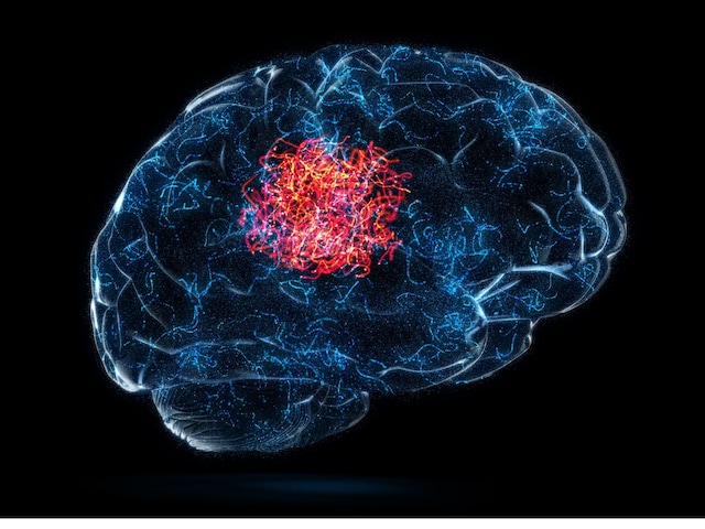 These 7 signs are continuously pointing to the brain tumor, this threat hovering over the head These 7 signs are continuously pointing to the brain tumor, this threat hovering over the head