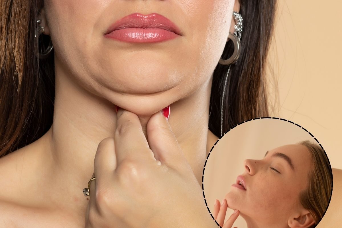 Causes of Double Chin: Here’s Why Submental Fat Develops