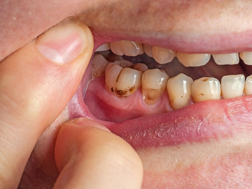 Teeth Cavity: दांतों में कैविटी, काला गड्ढा और मुंह की बदबू से हैं परशान? सिर्फ 1 चुटकी इस आयुर्वेदिक पाउडर से होगा चमत्कार Teeth Cavity: दांतों में कैविटी, काला गड्ढा और मुंह की बदबू से हैं परशान? सिर्फ 1 चुटकी इस आयुर्वेदिक पाउडर से होगा चमत्कार