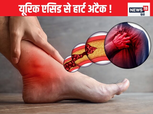 If uric acid is high, then the risk of heart attack will also increase, the risk of both