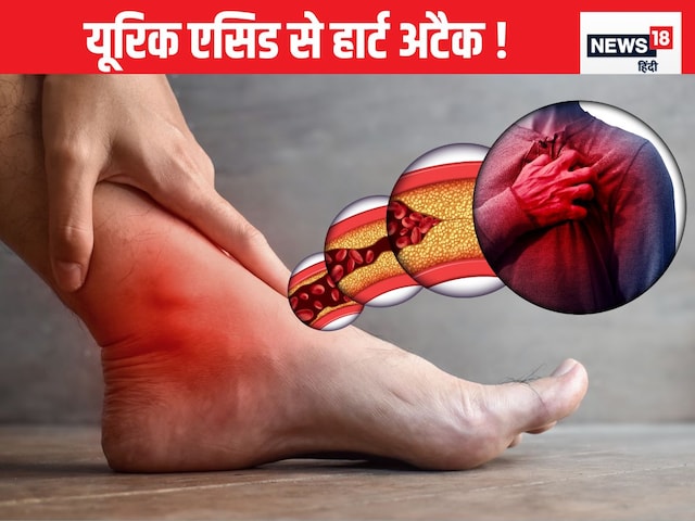 If uric acid is high, then the risk of heart attack will also increase, the risk of both If uric acid is high, then the risk of heart attack will also increase, the risk of both