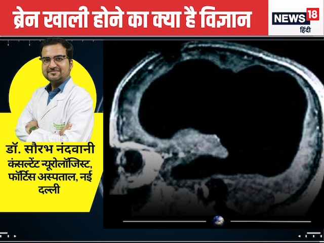 Is some people's mind really empty? Doctor also surprised by brain scan Is some people's mind really empty? Doctor also surprised by brain scan