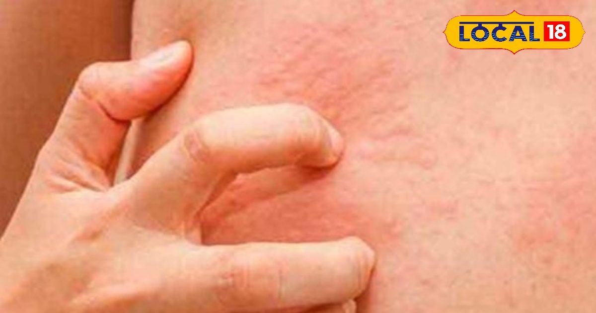Skin Care Tips: अगर बरसात में बढ़ जाए खुजली और रैशेज की समस्या, तो इस घरेलू उपाय से तगड़ा इलाज नहीं मिलेगा! जानें
