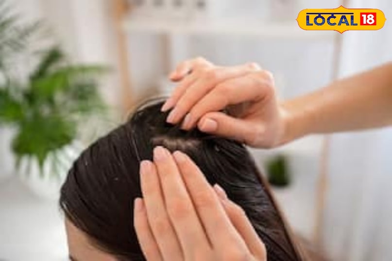 Monsoon hair care tips, Hair fall and dandruff solution, Home remedies, local18, khargone letest news, Madhya Pradesh hindi news 