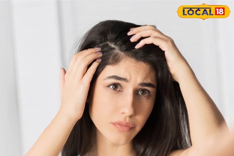 Home remedies for dandruff, Monsoon hair care tips, Hair fall and dandruff solution, Home remedies, local18, khargone letest news, Madhya Pradesh hindi news
