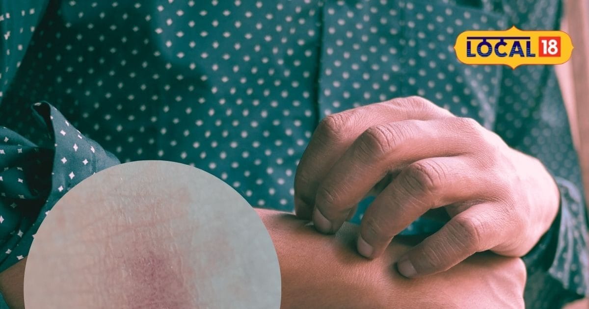पसीने के कारण शरीर में हो रही जलन-खुजली, तो अपनाएं ये घरेलू उपाय, झट से ...