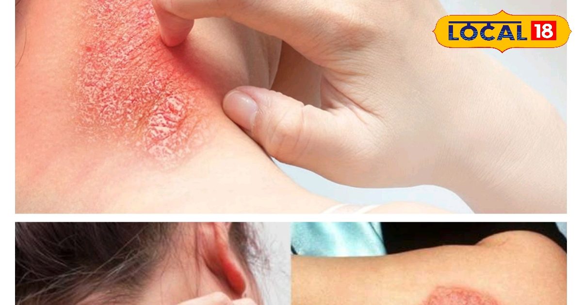 Skin care in rainy season : खुजाते-खुजाते लाल पड़ गया है शरीर? बारिश में खुजली से दूर रखेंगे ये 5 तरीके – Uttar Pradesh News