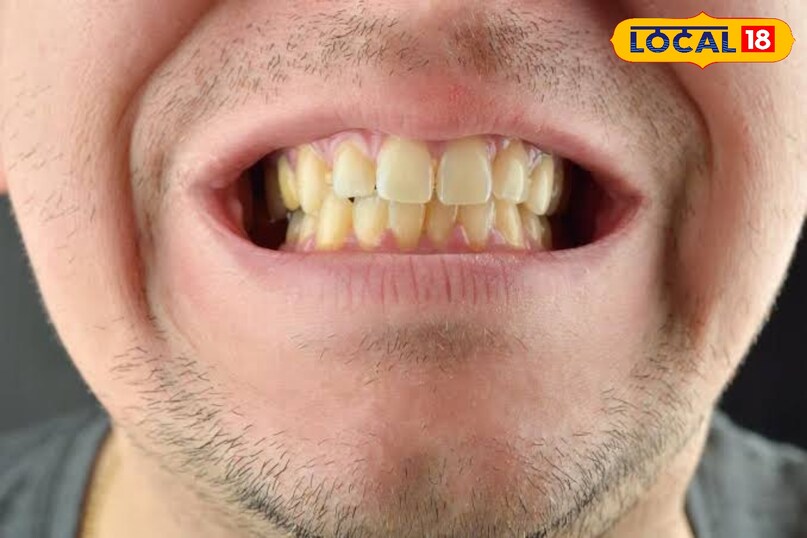 दांत पीले क्यों होते हैं? दांतों के पीले होने के कई कारण हो सकते हैं, खान-पान की आदतें कुछ खाद्य पदार्थ और पेय दांतों को पीला कर देते हैं, जैसे कॉफी, चाय और कोला इनमें टैनिन होता है जो दांतों पर दाग छोड़ता है। रेड वाइन इसका गहरा रंग दांतों को पीला कर सकता है। सोया सॉस, टमाटर सॉस ये भी दांतों का रंग बदल सकते है धूम्रपान और तंबाकू दांतों को पीला या भूरा कर देते हैं।