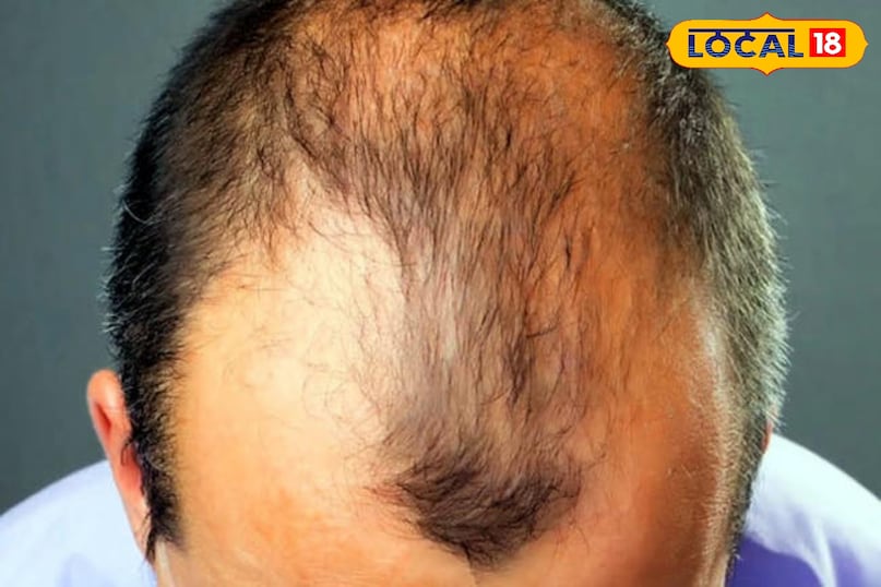 Home Remedies for Baldness, Hair Fall Treatment, Natural Treatment for Hair Loss, Tips and Trick, Local18, Khargone Letest News, Madhya Pradesh Hindi News 