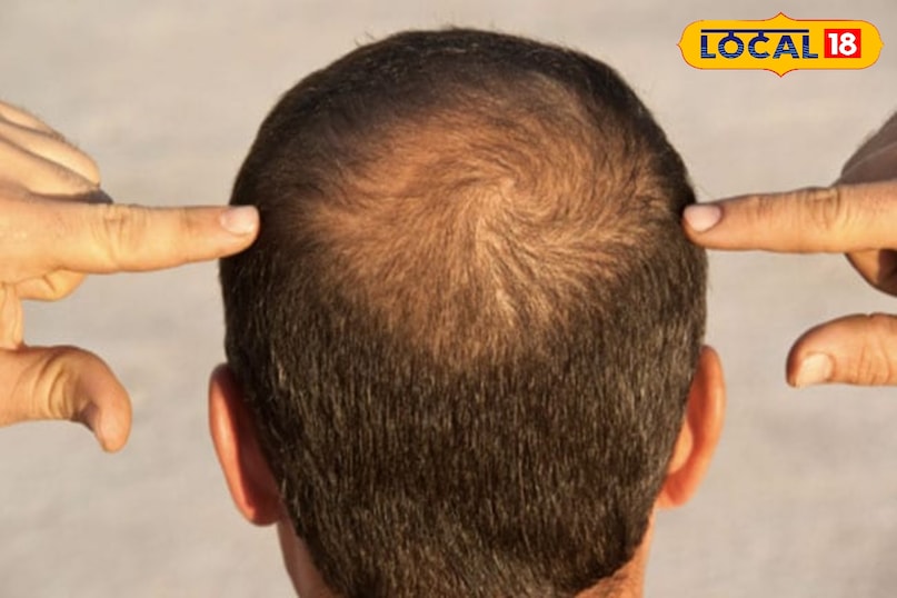 Home Remedies for Baldness, Hair Fall Treatment, Natural Treatment for Hair Loss, Tips and Trick, Local18, Khargone Letest News, Madhya Pradesh Hindi News 