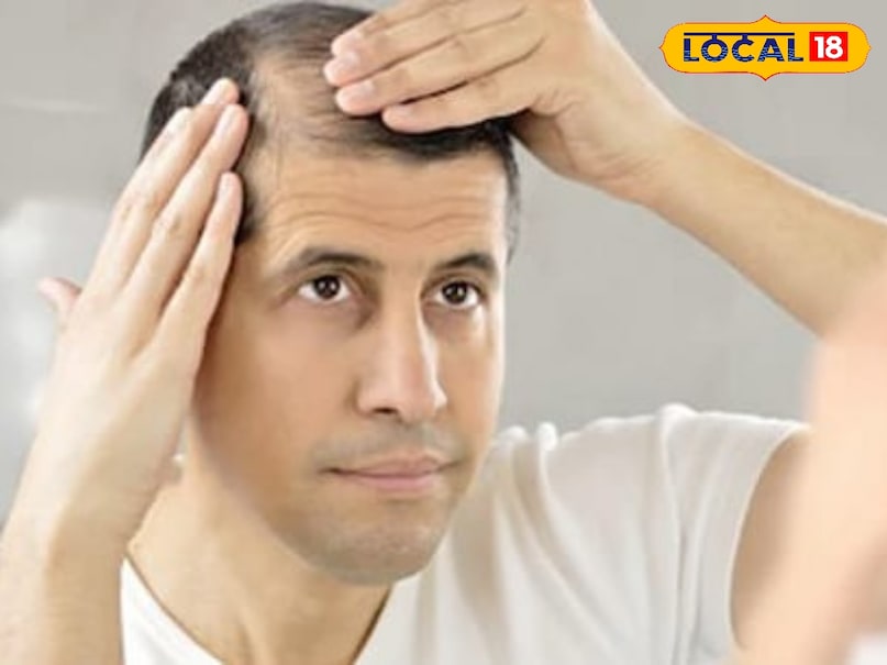 Hair regrowth at home, hairfall treatment, regrow hair naturally, Home remedies for baldness, Hair fall natural treatment, Natural treatment for hair loss, Tips and tricks for hair fall, local 18, khargone news, Madhya Pradesh news