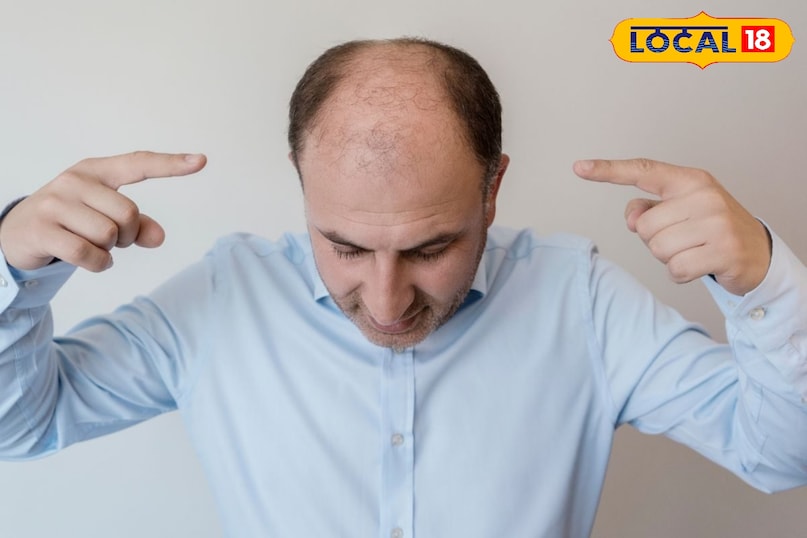 Home Remedies for Baldness, Hair Fall Treatment, Natural Treatment for Hair Loss, Tips and Trick, Local18, Khargone Letest News, Madhya Pradesh Hindi News 