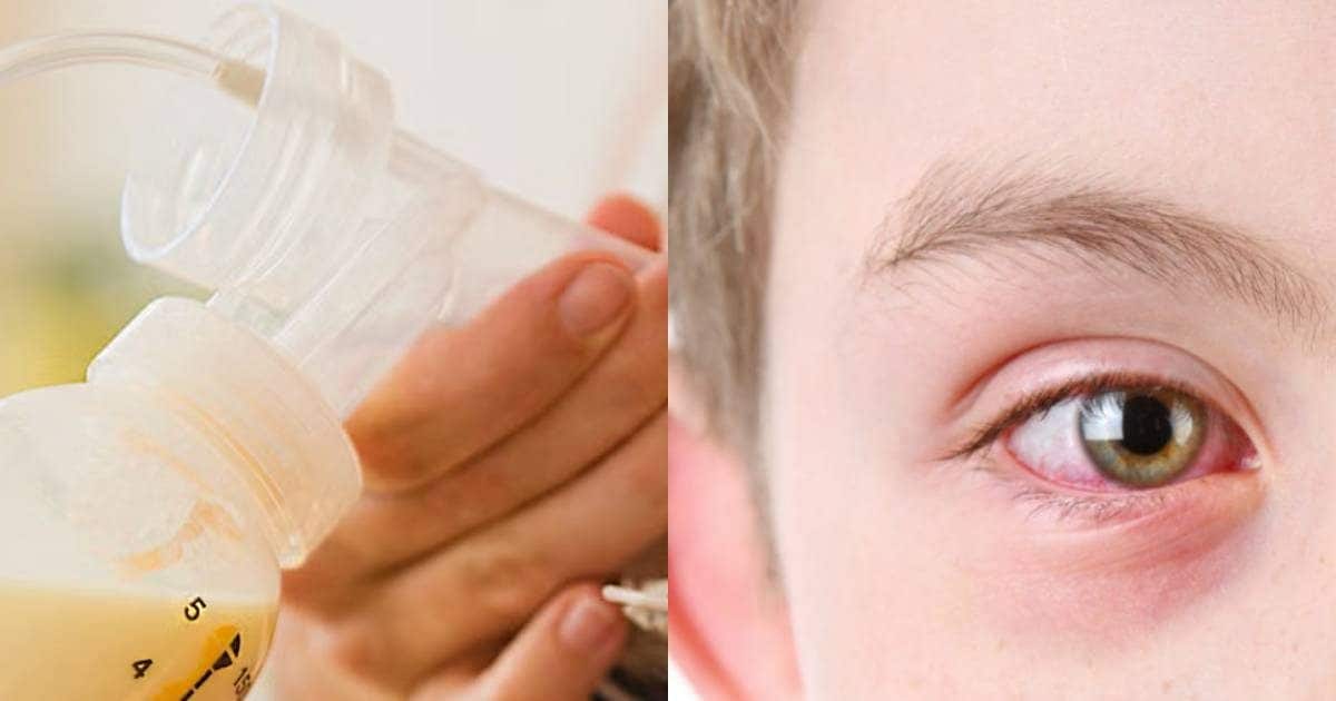 can i put breast milk in baby eyes for conjunctivitis\ conjunctivitis myths, कंजक्‍ट‍िवाइटिस का इलाज\बच्‍चों की आंखों में ब्रेस्‍ट मिल्‍क
